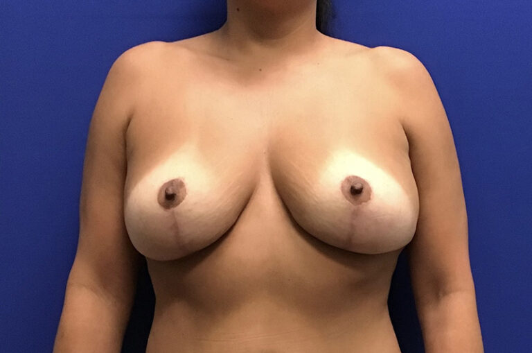 After Image: Breast Explant - front
