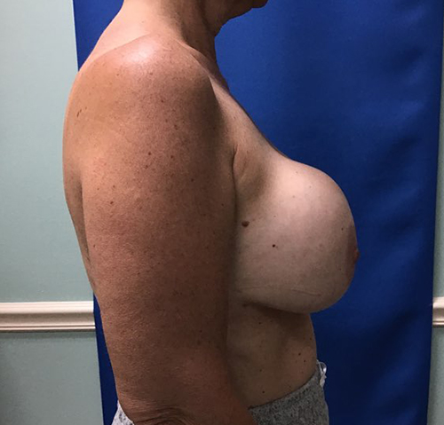 Before Image: Breast Explant - right-side
