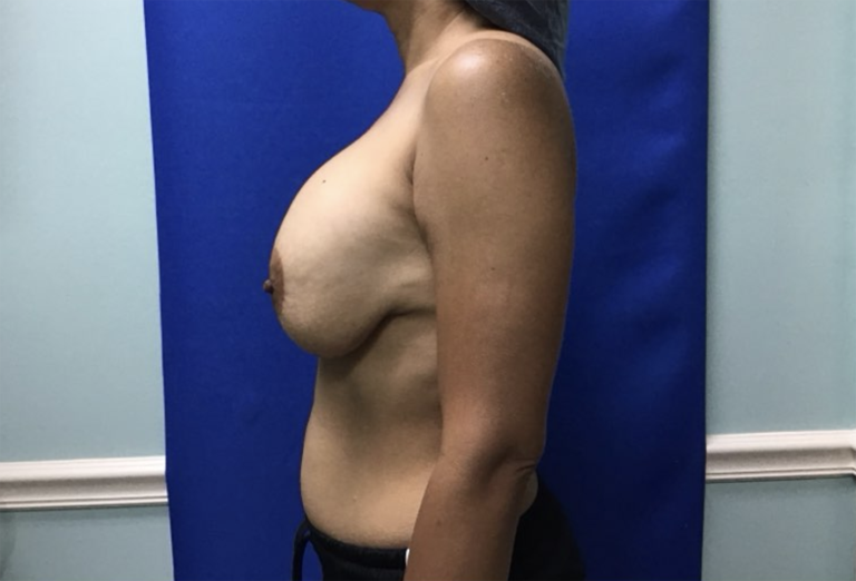 Before Image: Breast Explant - left-side