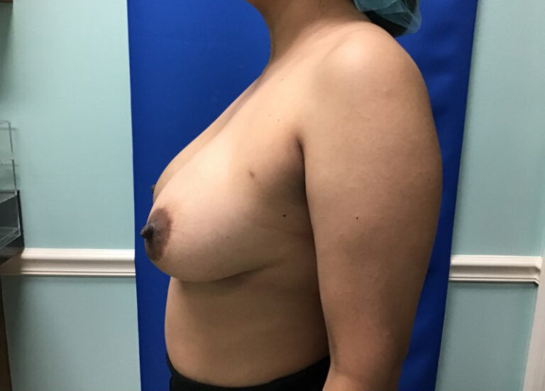 Before Image: Breast Explant - left-side