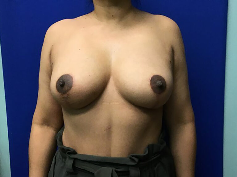 After Image: Breast Explant - front
