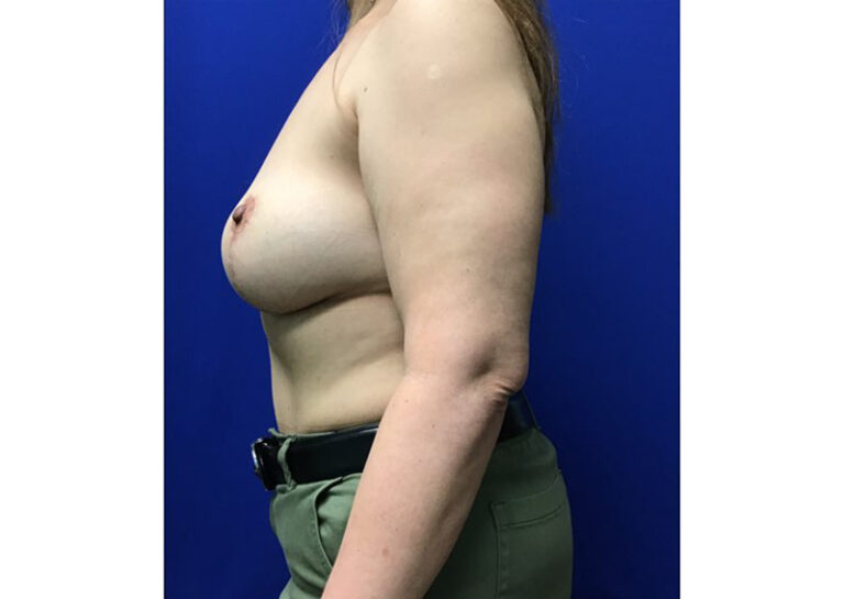 After Image: Breast Explant - left-side