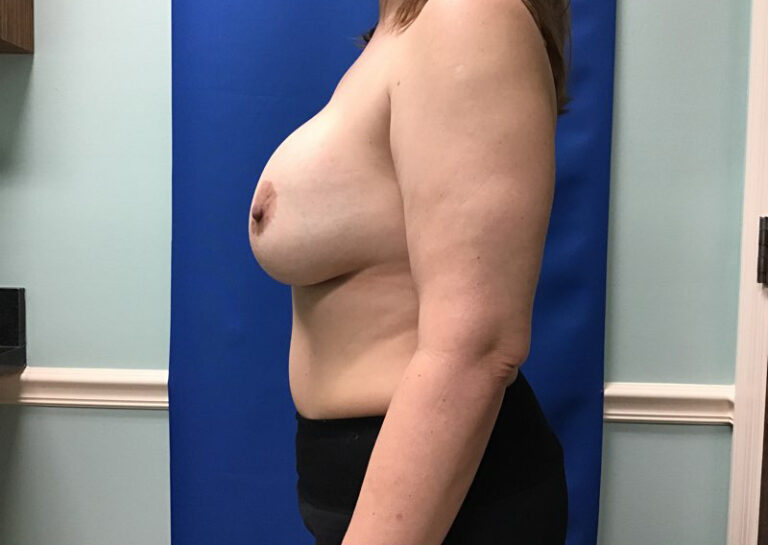 Before Image: Breast Explant - left-side