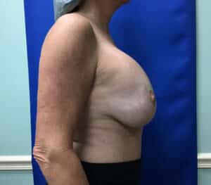 Before Image: Breast Explant