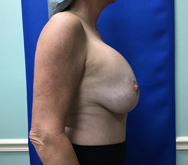 Before Image: Breast Explant - right-side