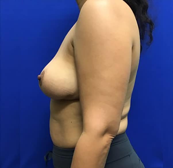 After Image: Breast Explant - left-side