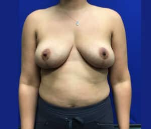 After Image: Breast Explant