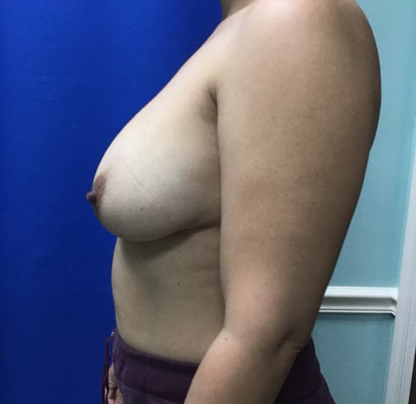 Before Image: Breast Explant - left-side
