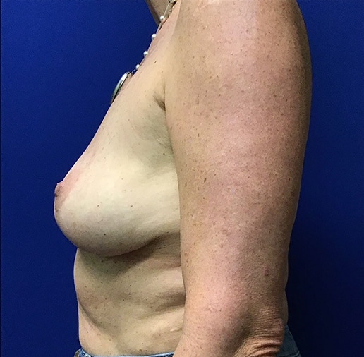 After Image: Breast Explant - left-side