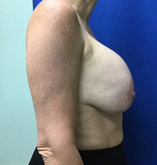 Before Image: Breast Explant - right-side