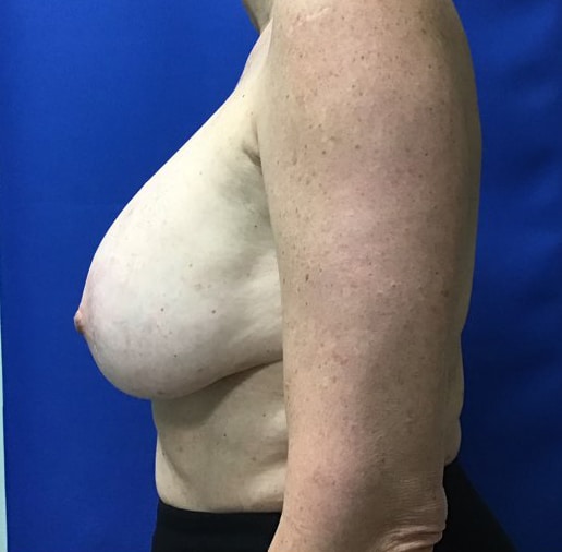 Before Image: Breast Explant - left-side