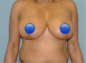 After Image: Breast Reduction Surgery: 2 Months Post Op
