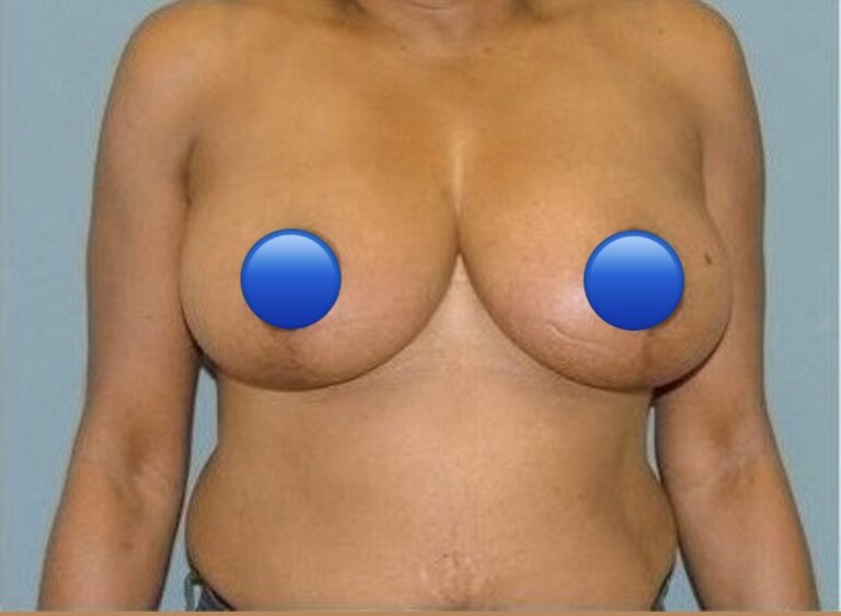 After Image: Breast Reduction Surgery: 2 Months Post Op - front