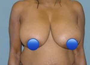 Before Image: Breast Reduction Surgery: 2 Months Post Op