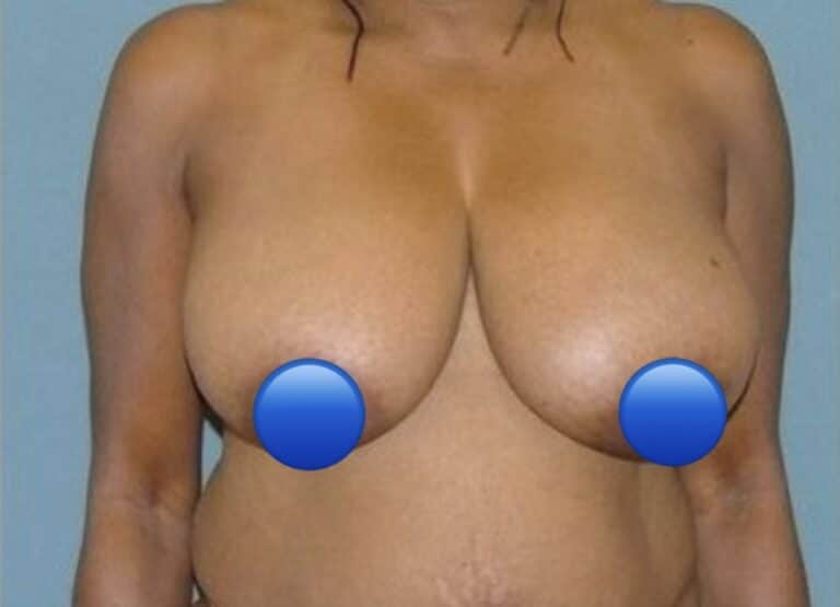 Before Image: Breast Reduction Surgery: 2 Months Post Op - front