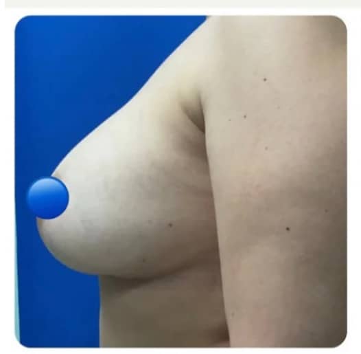 Before Image: Breast Explant Surgery and Breast Lift: 6 Weeks Post Op - front