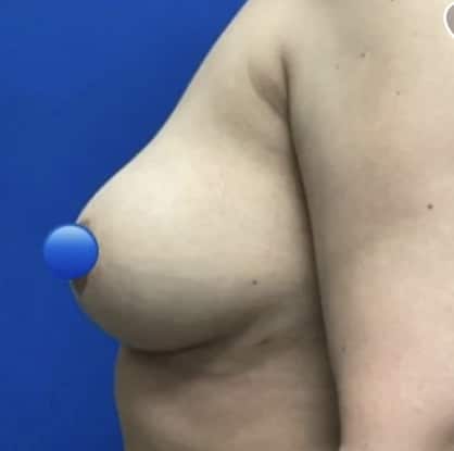After Image: Breast Explant Surgery and Breast Lift: 6 Weeks Post Op - front