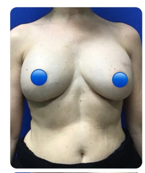 Before Image: Breast Explant Surgery NO LIFT: 8 Months Post Op - front