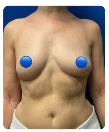 After Image: Breast Explant Surgery NO LIFT: 8 Months Post Op - front