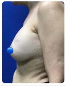 Before Image: Breast Explant Surgery NO LIFT: 8 Months Post Op