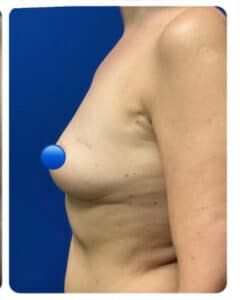 After Image: Breast Explant Surgery NO LIFT: 8 Months Post Op