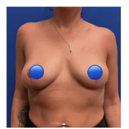 After Image: Breast Explant and Breast Lift: 1 Month Post Op - front