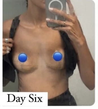 After Image: Breast Explant Surgery and Lift: 6 DAYS Post Op - front