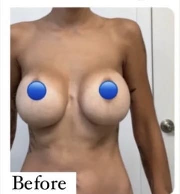 Before Image: Breast Explant Surgery and Lift: 6 DAYS Post Op - front