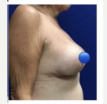 After Image: Breast Explant Surgery and Lift: 3 Weeks Post Op - right-side