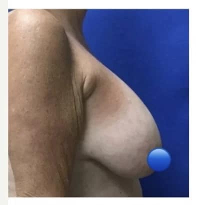 Before Image: Breast Explant Surgery and Lift: 3 Weeks Post Op - right-side