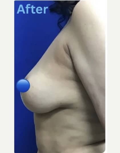 After Image: Breast Explant Surgery and Lift - front
