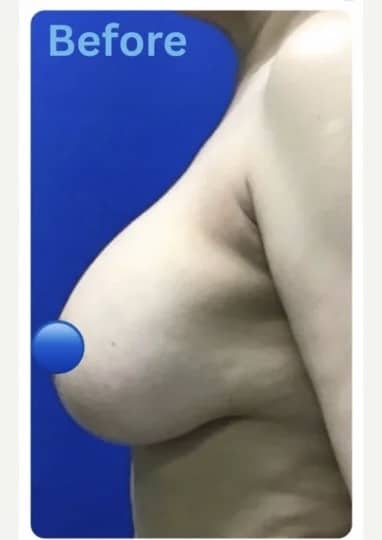 Before Image: Breast Explant Surgery and Lift - front