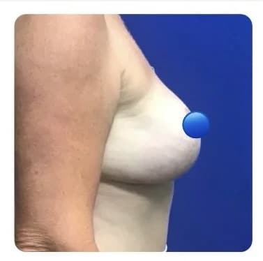 After Image: Breast Explant Surgery and Lift: 4 Months Post Op - right-side