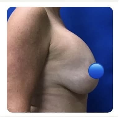 Before Image: Breast Explant Surgery and Lift: 4 Months Post Op - right-side