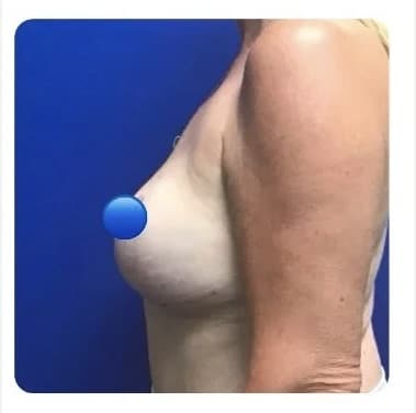 After Image: Breast Explant Surgery and Lift: 4 Months Post Op - left-side