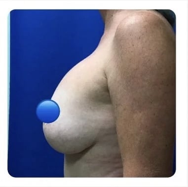 Before Image: Breast Explant Surgery and Lift: 4 Months Post Op - left-side