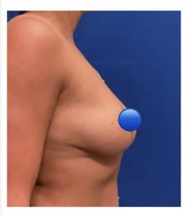 After Image: Breast Explant and Breast Lift: 1 Month Post Op - right-side