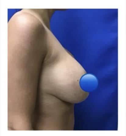 Before Image: Breast Explant and Breast Lift: 1 Month Post Op - right-side
