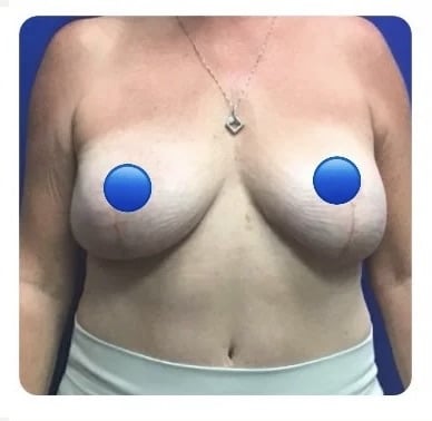 After Image: Breast Explant Surgery and Lift: 4 Months Post Op - front