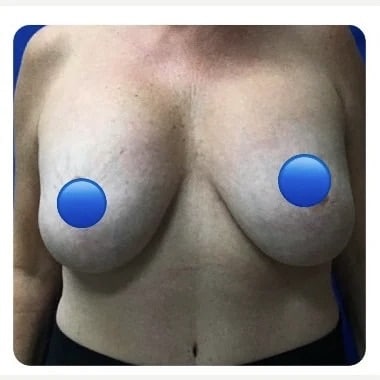 Before Image: Breast Explant Surgery and Lift: 4 Months Post Op - front