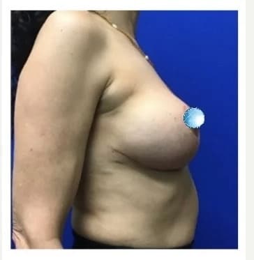 After Image: Breast Explant Surgery and Lift: 1 Month Post Op - right-side