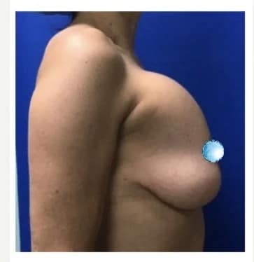 Before Image: Breast Explant Surgery and Lift: 1 Month Post Op - right-side