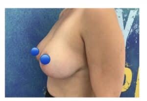 After Image: Breast Reduction Surgery