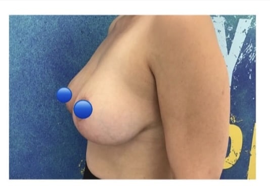 After Image: Breast Reduction Surgery - left-side