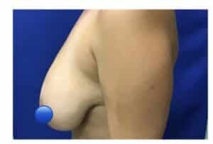 Before Image: Breast Reduction Surgery