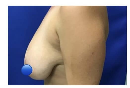 Before Image: Breast Reduction Surgery - left-side