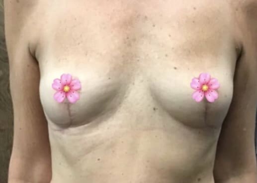 After Image: Breast Explant Surgery and Lift: 1 Month Post Op - front