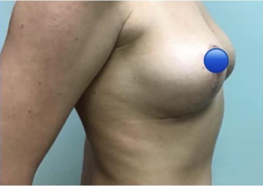 After Image: Breast Explant Surgery and Lift - right-side