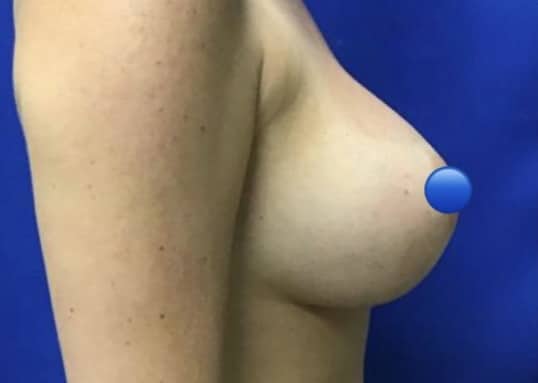 Before Image: Breast Explant Surgery and Lift - right-side