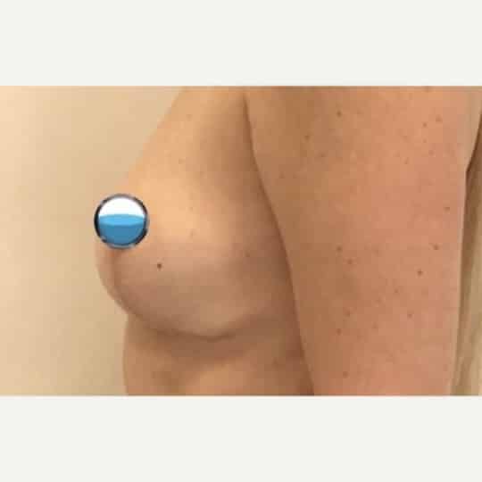 After Image: Breast Explant Surgery with Lift - left-side